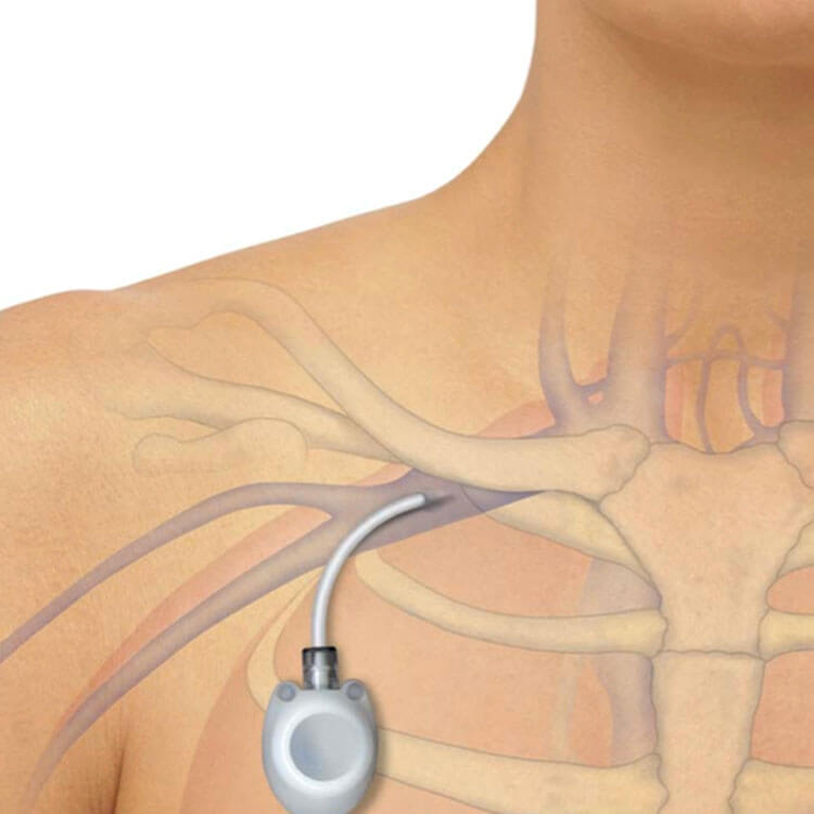 Quimioterapia
